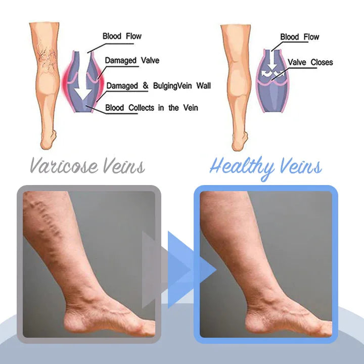 ✨Today's Limited Time Specials ✨MEDix™ Varicose Veins Spray