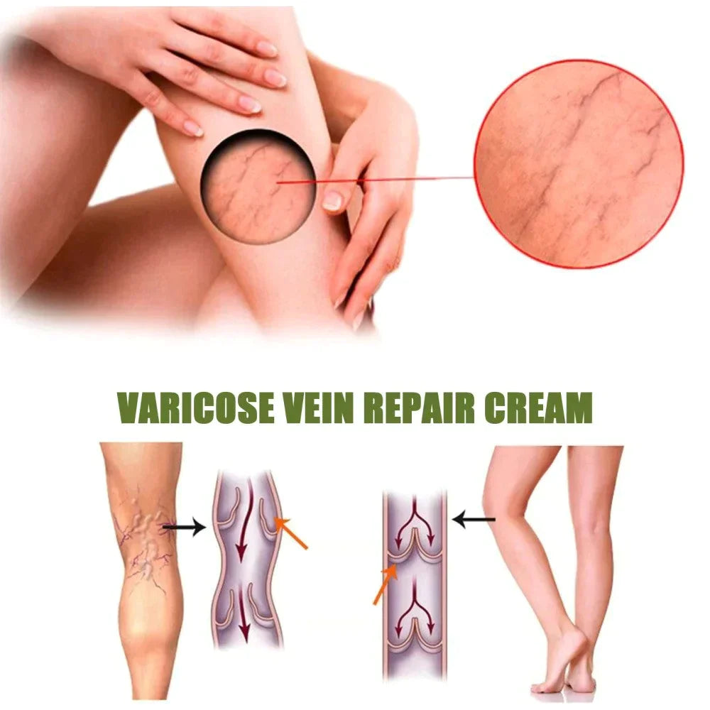 ✨Today's Limited Time Specials ✨MEDix™ Varicose Veins Spray