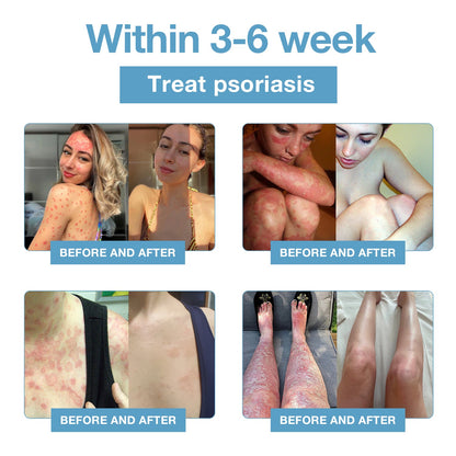 🌞Bee Venom & Ocean Natural Eczema Psoriasis Relief Cream (For all skin conditions)